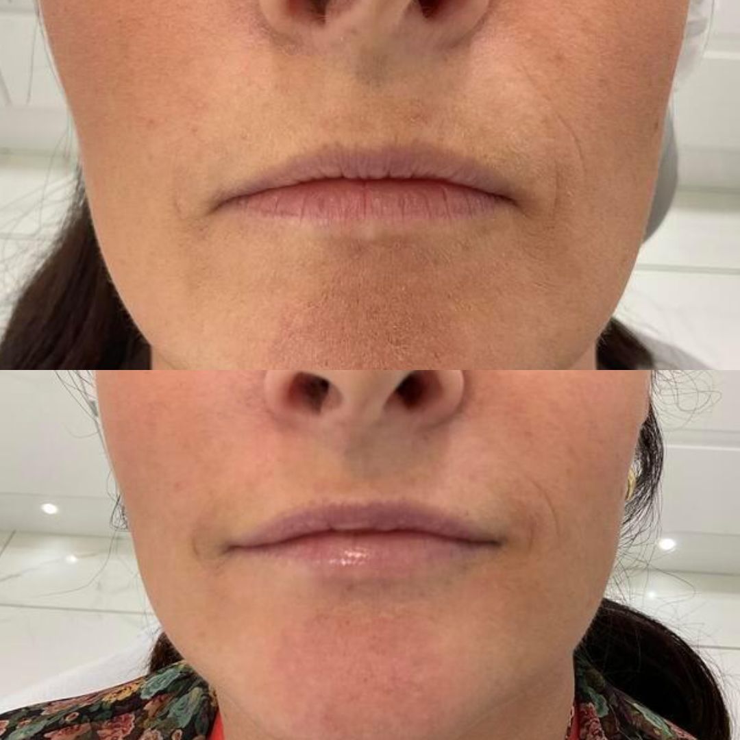 Dermal Filler — Immaculate Makeup
