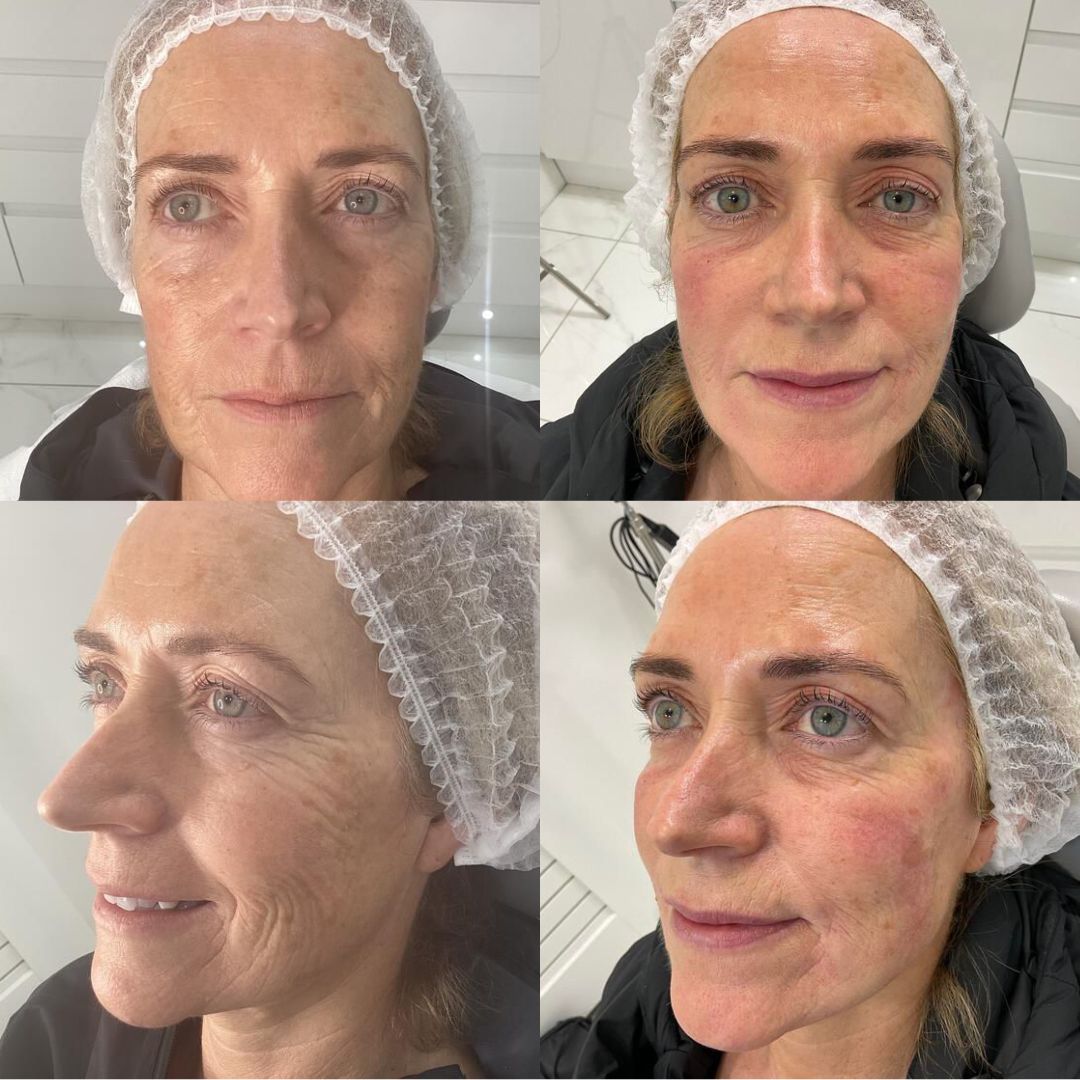 Dermal Filler — Immaculate Makeup
