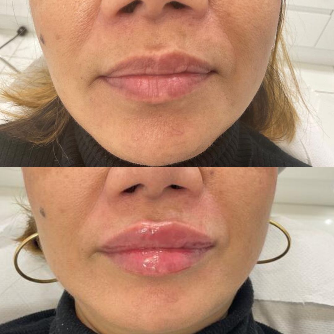Dermal Filler — Immaculate Makeup