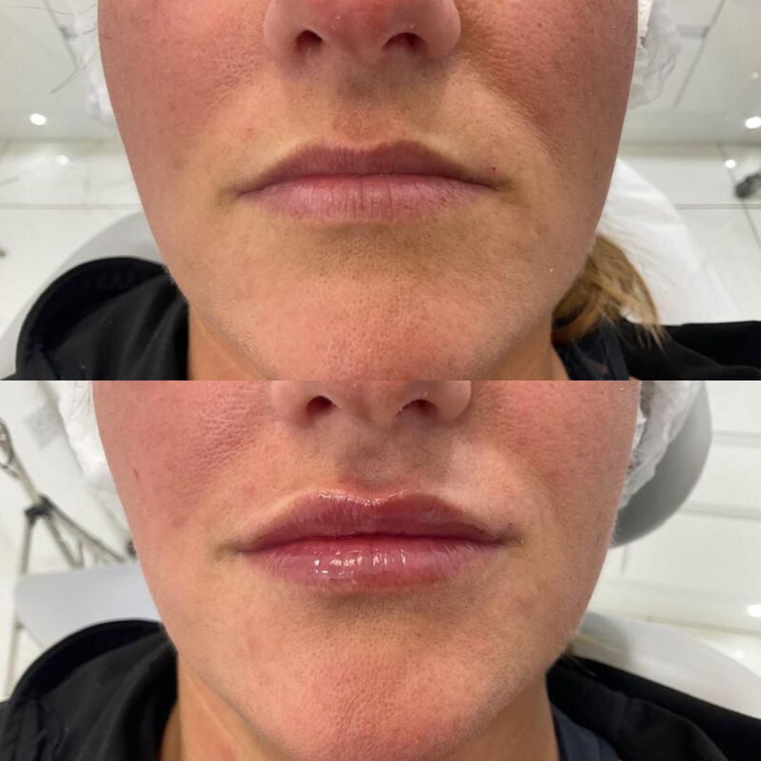 Dermal Filler — Immaculate Makeup