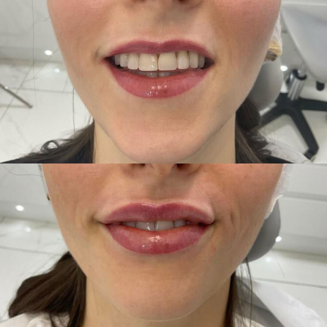 Dermal Filler — Immaculate Makeup