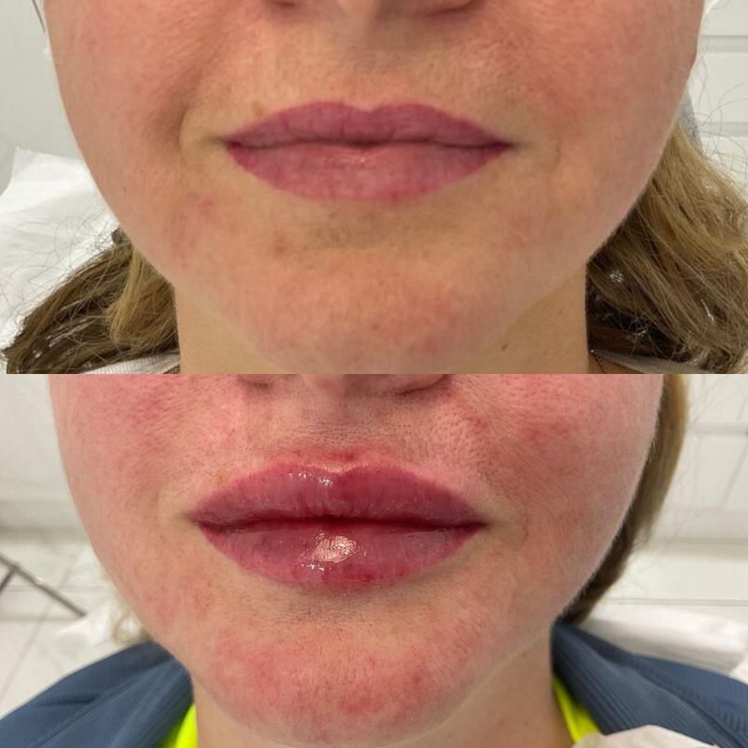 Dermal Filler — Immaculate Makeup