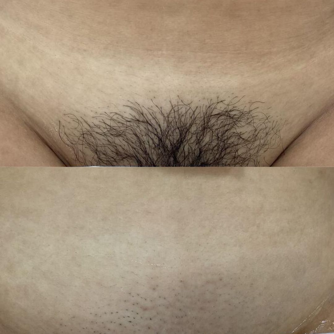 Laser Hair Removal — Immaculate Makeup