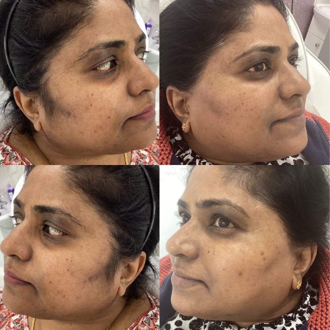 Laser Hair Removal — Immaculate Makeup