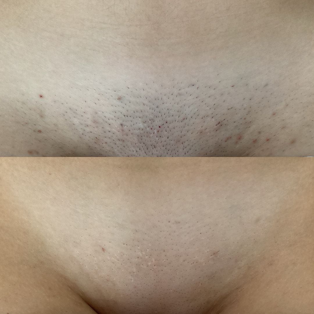 Laser Hair Removal — Immaculate Makeup