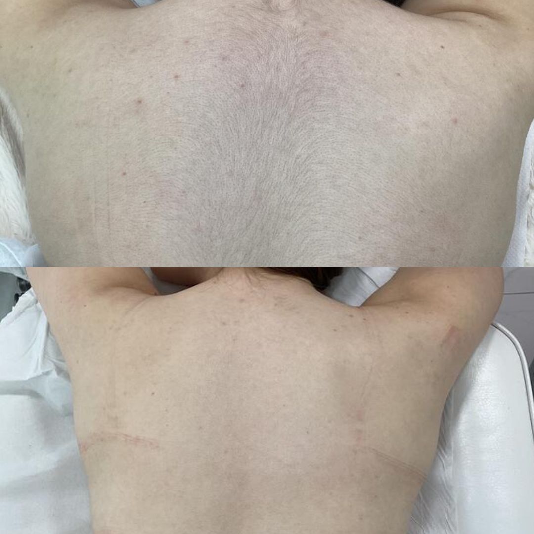 Laser Hair Removal — Immaculate Makeup