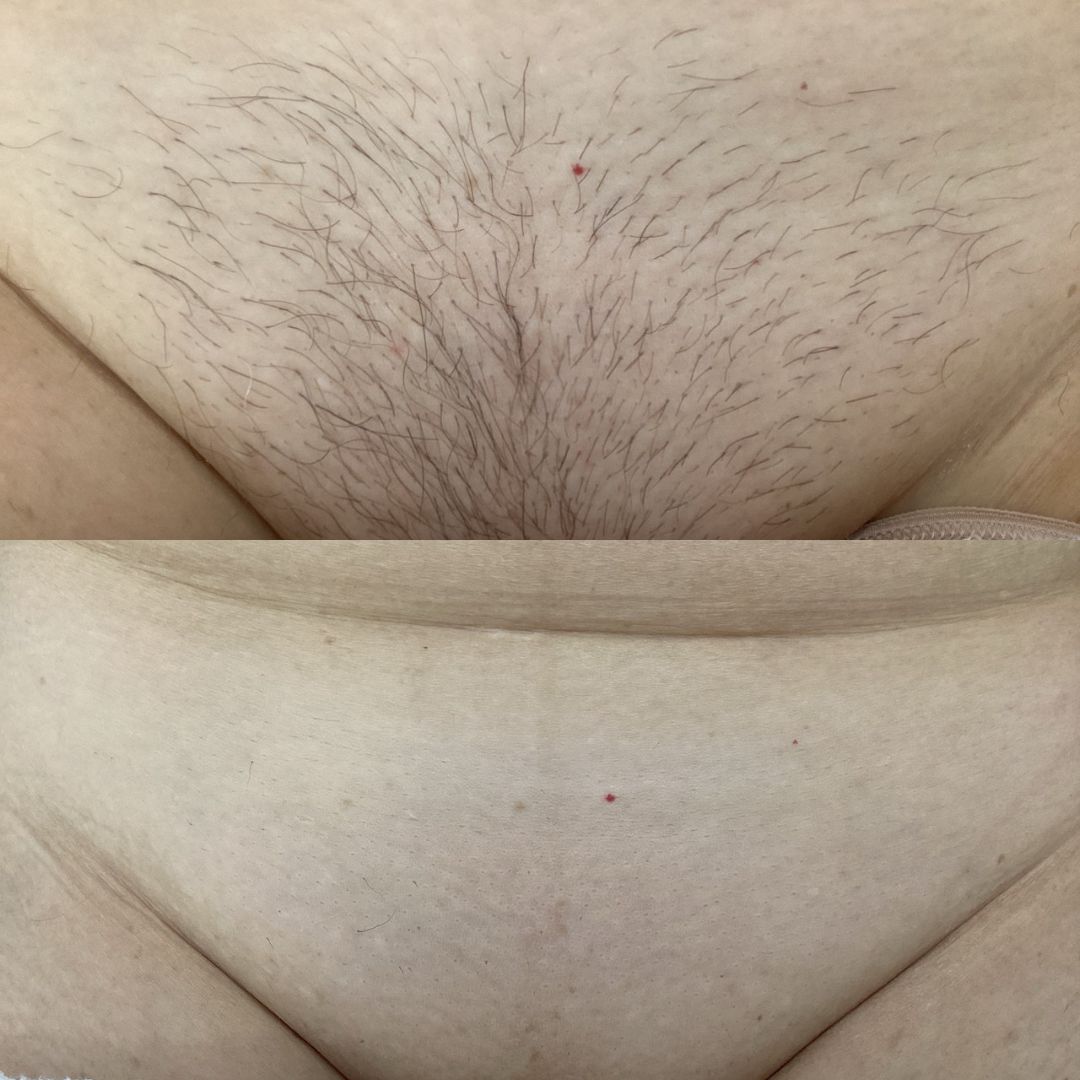 Laser Hair Removal — Immaculate Makeup