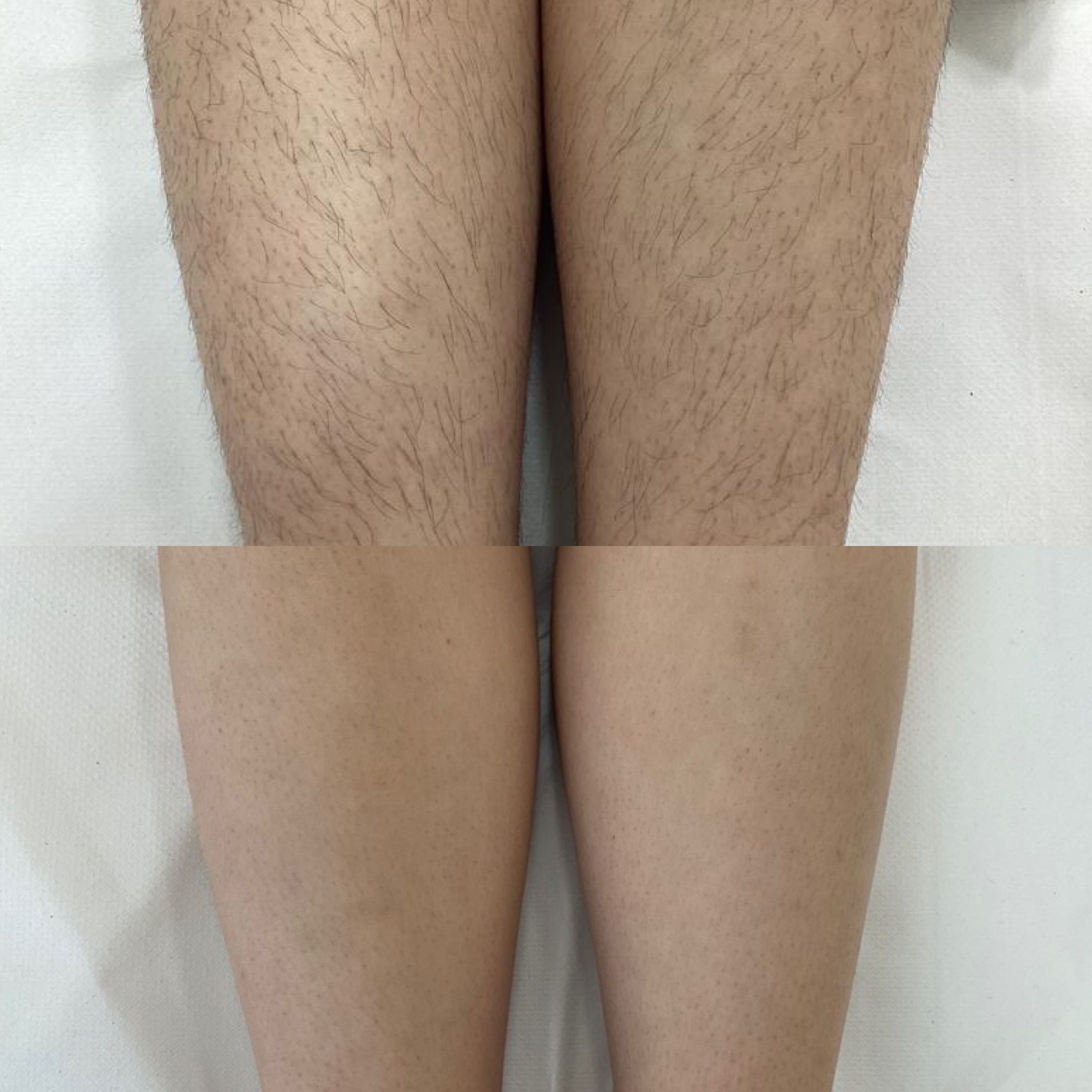 Laser Hair Removal — Immaculate Makeup