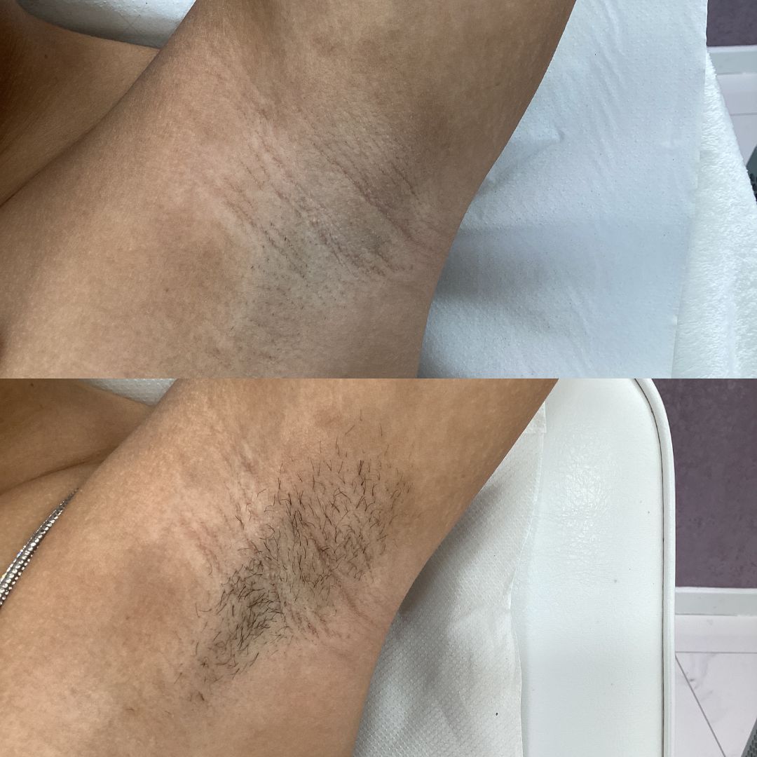 Laser Hair Removal — Immaculate Makeup