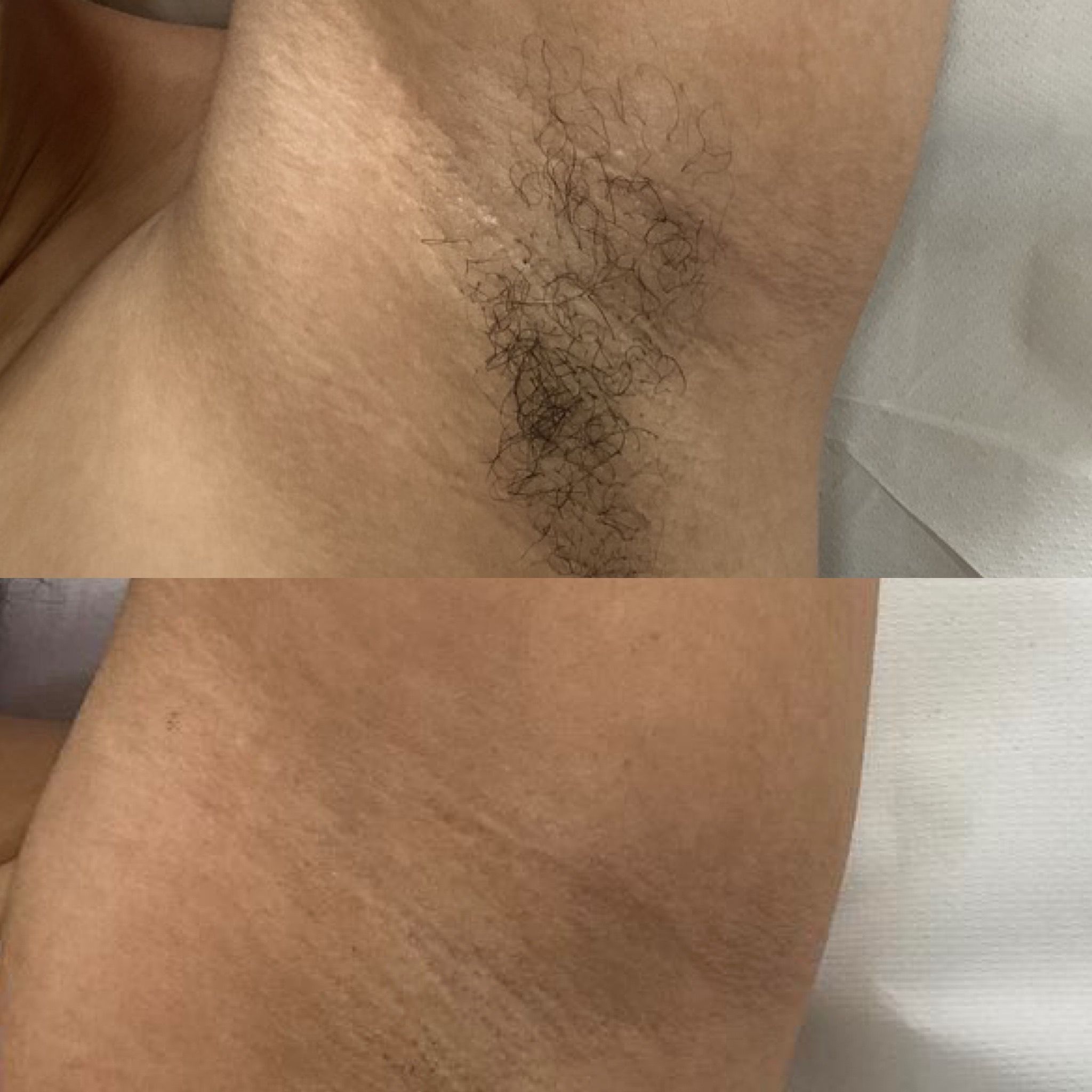 Laser Hair Removal — Immaculate Makeup