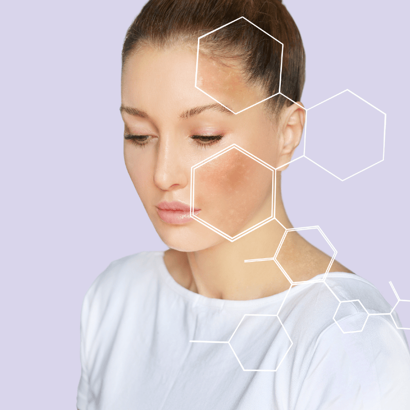 Vitaran polynucleotides bio-revitalising treatment